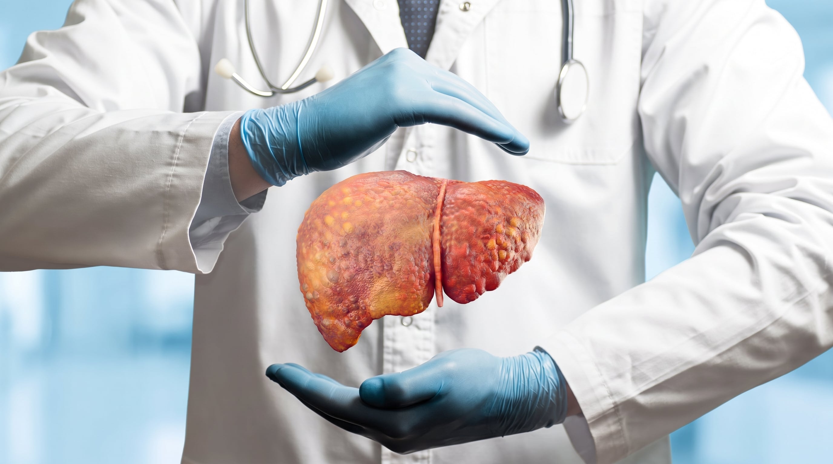 El hepatocarcinoma es el tipo más frecuente de cáncer primario de hígado a nivel mundial (Imagen Ilustrativa Infobae)