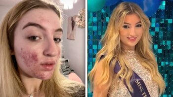 Una joven con acné denunció