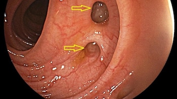 Divertículos en el colon: Qué
