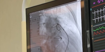 La tecnología utilizada permite que el dispositivo se absorba en un año, evitando cirugías futuras para retirarlo