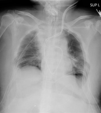 Radiografía pulmonar de la primera