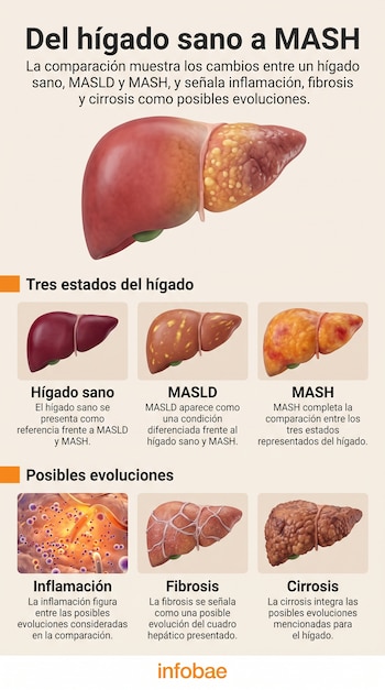 Infografía con ilustraciones de un hígado sano, MASLD y MASH, junto con fases de inflamación celular, fibrosis y cirrosis sobre fondo claro.