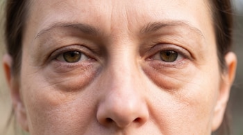 Primer plano del rostro de una mujer con ojos color avellana y bolsas pronunciadas debajo de ellos. Se aprecian líneas finas en la piel del contorno ocular.