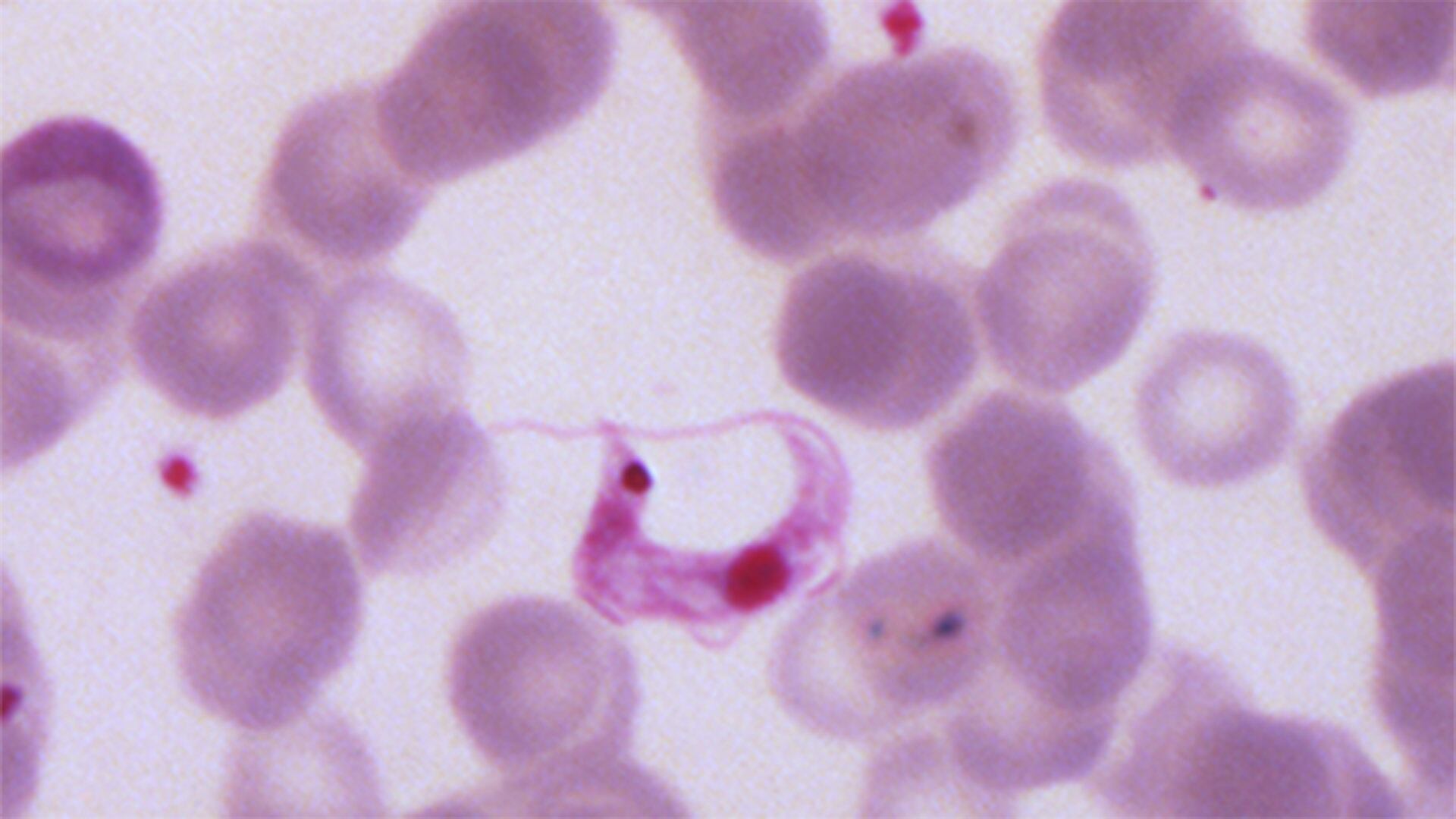 La enfermedad de Chagas tiene dos etapas o fases clínicas: una fase aguda y una fase crónica (CDC)