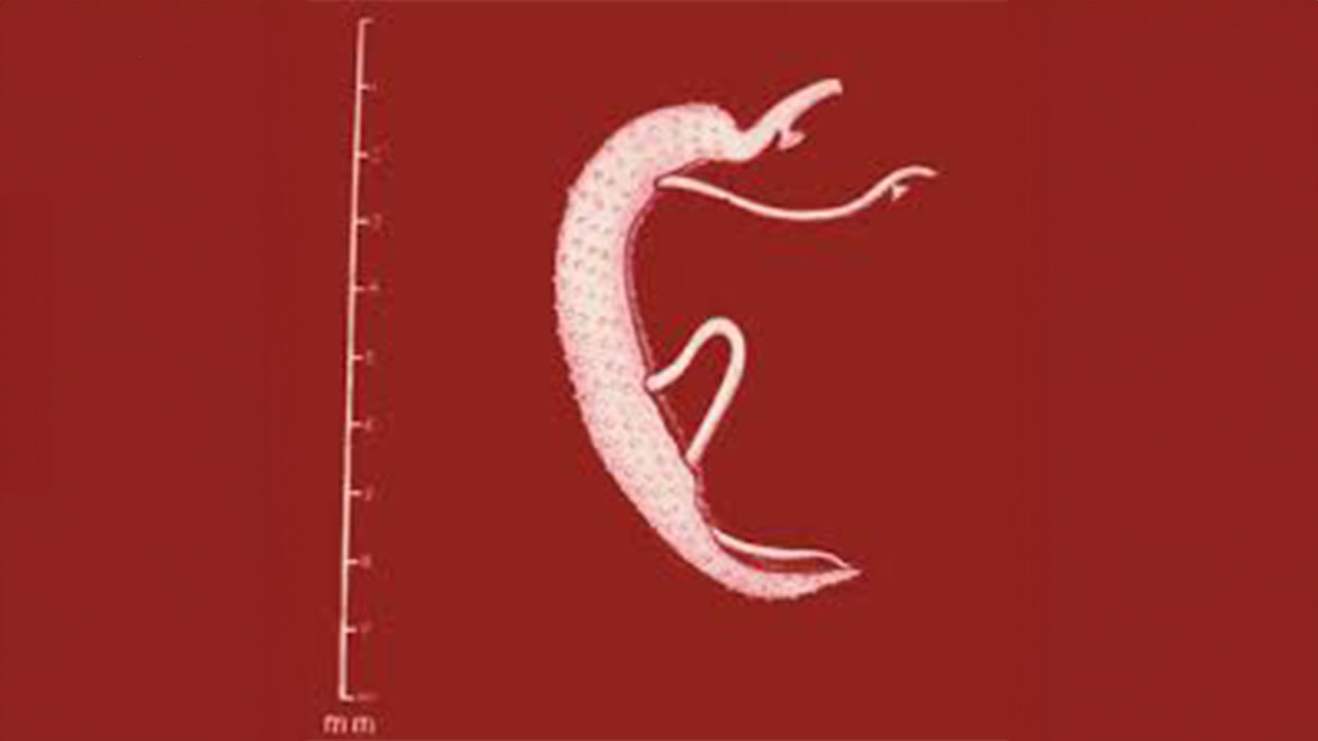 La esquistosomiasis es una enfermedad parasitaria causada por gusanos del género Schistosoma (CDC)