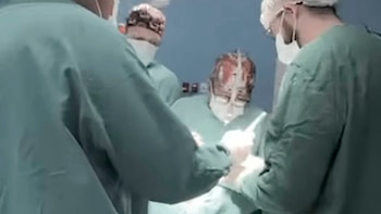 Un hombre vivió más de 10 años con un tumor de 15 centímetros en el rostro y médicos lo extirparon con planificación 3D