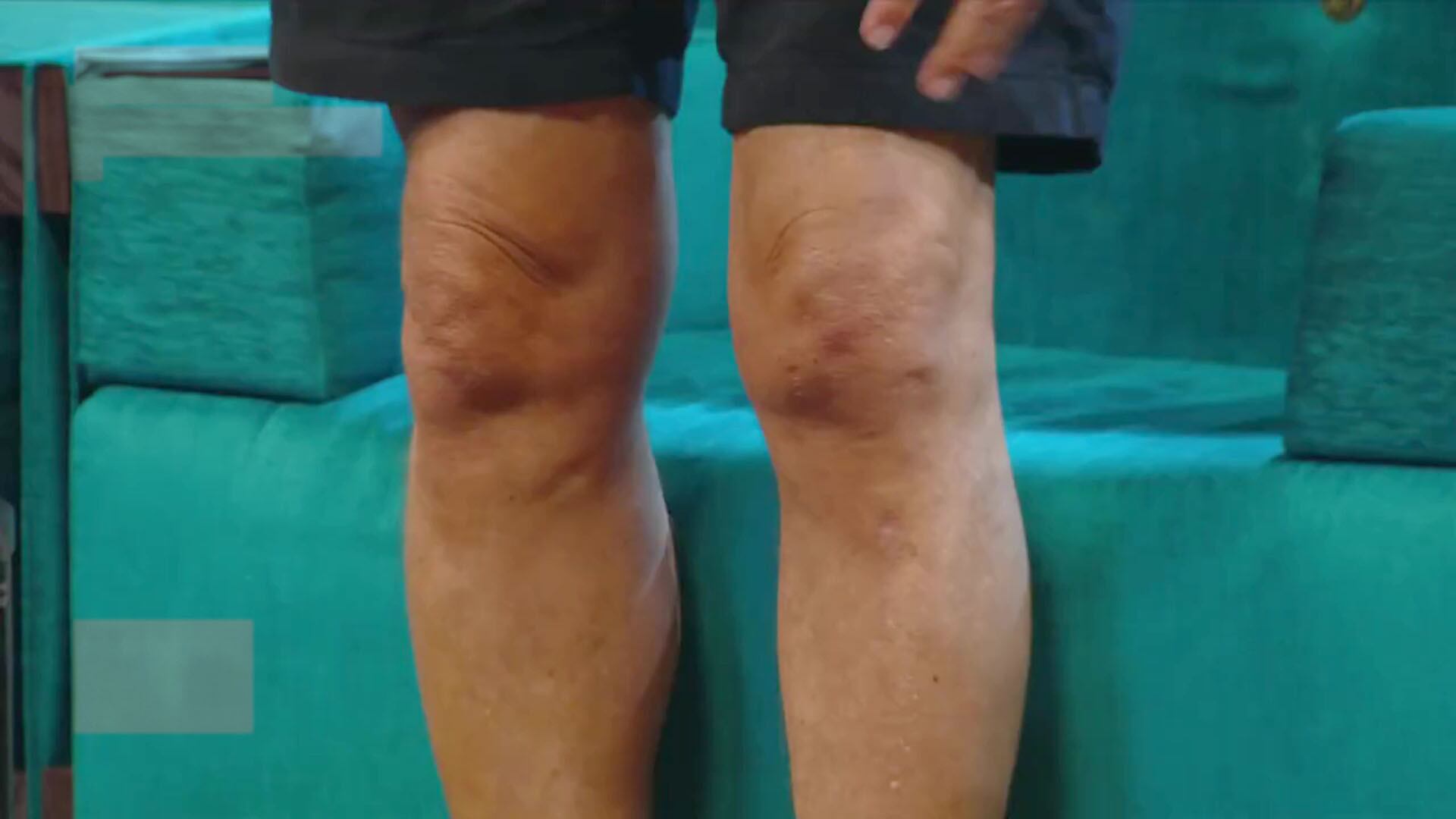 Jylio Bocca al momento de mstrar sus rodillas, blanco de varias lesiones e internaciones (Captura de TV)