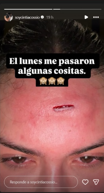 Cintia Cossio montró la lesión que se hizo y generó preocupación - crédito @soycintiacossio/IG