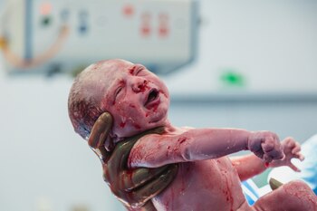 La episiotomía es cuando se