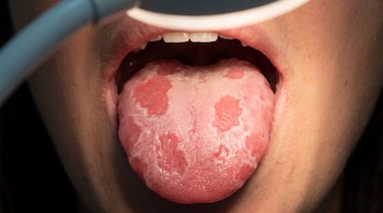 Boca abierta con lengua, mostrando manchas rojas y blancas. Un instrumento azul claro y una luz iluminan la cavidad oral.