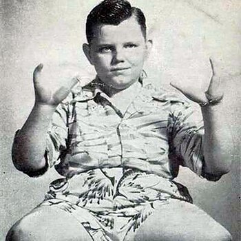 La ectrodactilia es una deformidad