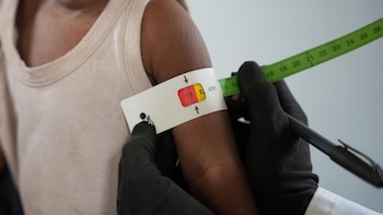 UNICEF alerta de que uno de cada cuatro niños en Yemen sufren desnutrición aguda en pleno repunte de los combates