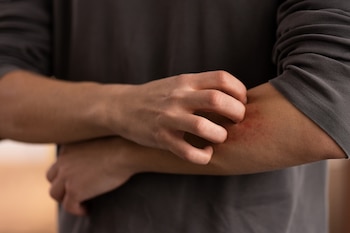 Un hombre se rasca la picadura de un mosquito (Magnific)