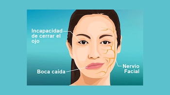 La parálisis facial periférica, conocida