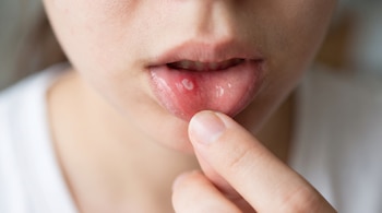 Primer plano de la boca de una persona que retira el labio inferior con un dedo y muestra una pequeña lesión blanca redondeada.