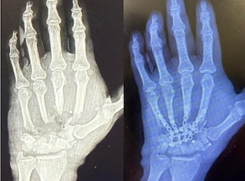 Imagen dividida mostrando dos radiografías de una mano: a la izquierda, la mano con huesos fragmentados; a la derecha, la mano reconstruida con implantes metálicos