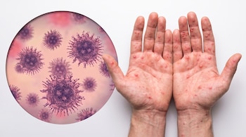 Dos manos abiertas muestran múltiples erupciones rojizas en palmas y dedos, junto a un círculo con virus morados microscópicos sobre fondo blanco.