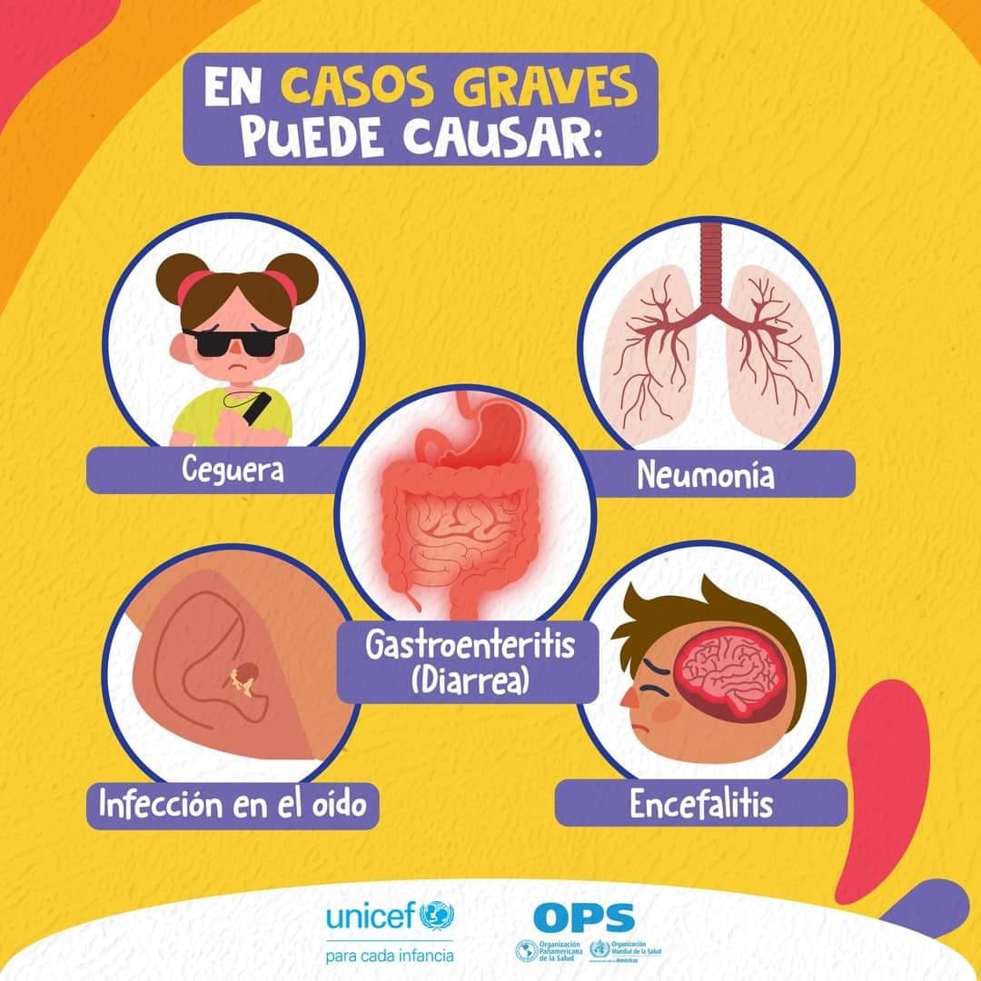 El sarampión puede derivar en neumonía, lesiones cerebrales ceguera, infección en el oído y gastroenteritis. (Cortesía: OPS/OMS El Salvador)
