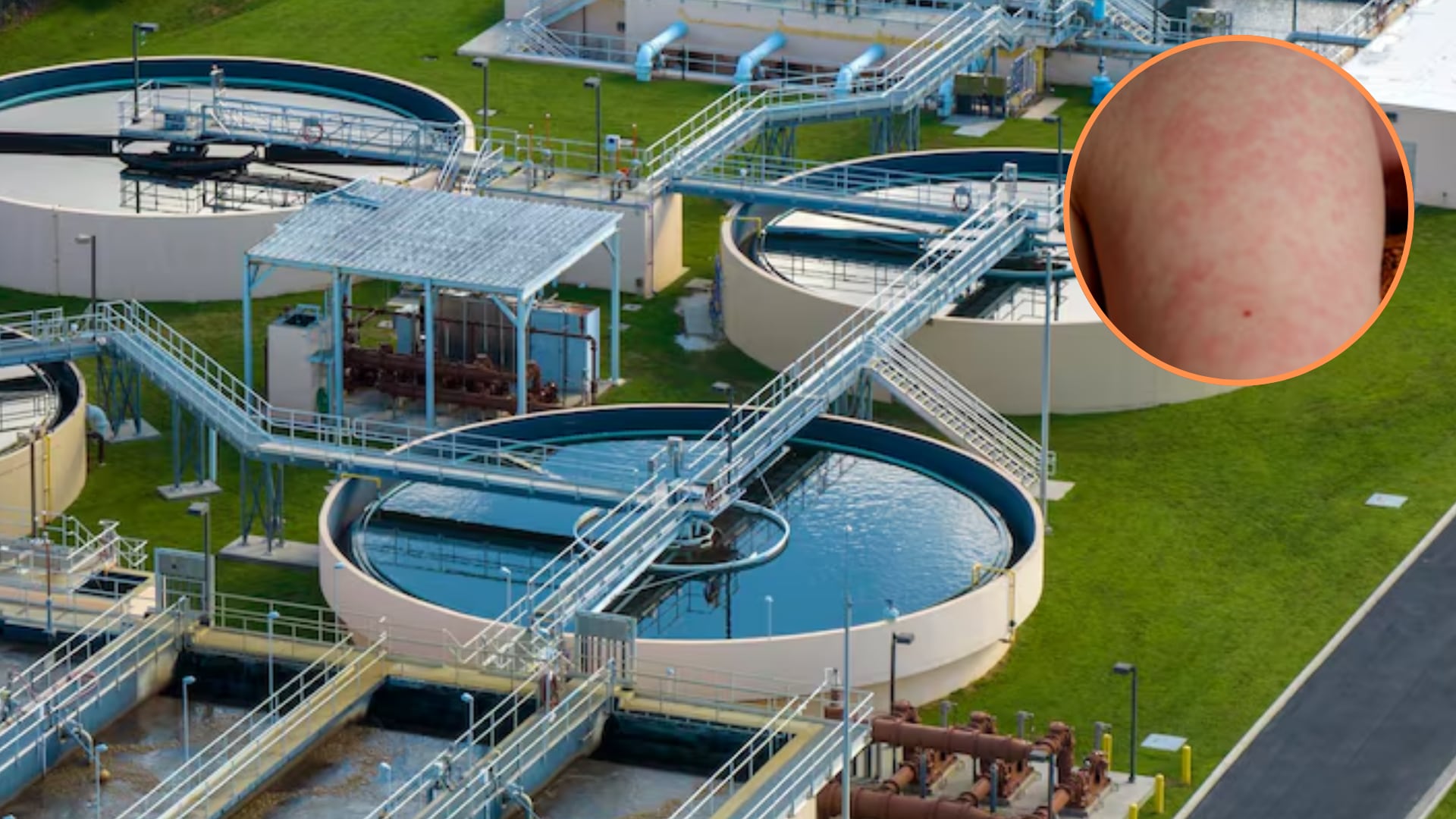 El aumento de casos de sarampión en Estados Unidos pone en cuestión la capacidad del país para sostener la eliminación de la enfermedad (Freepik)