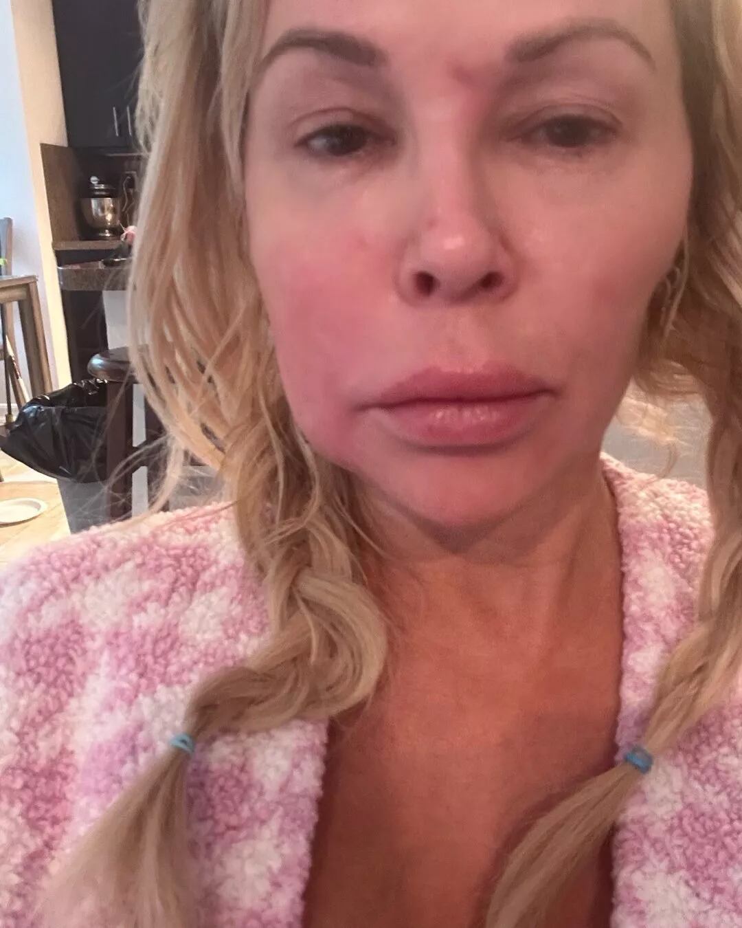 La actriz informó que también deberá retirarse metales de un trabajo dental viejo, quitarse los implantes mamarios y afrontar entre 4 y 6 meses de tratamiento intravenoso diario (X/Brandi Glanville)