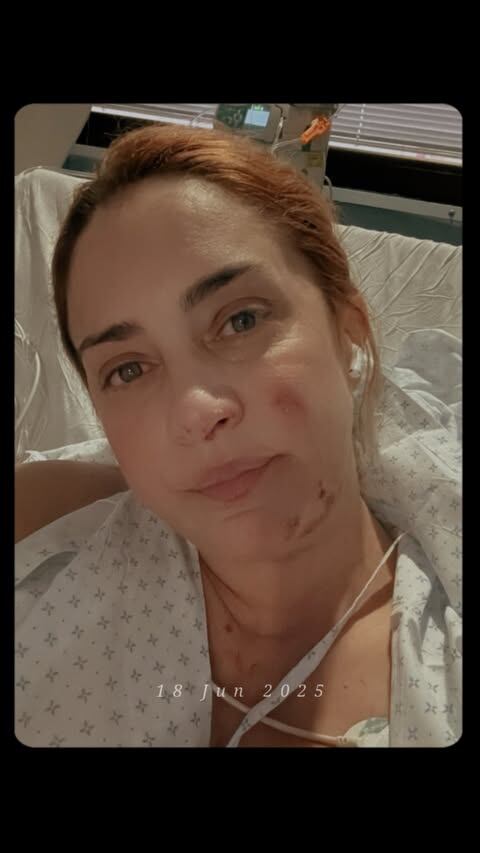 María Julia Oliván mostró cómo quedó su cara después del incendio