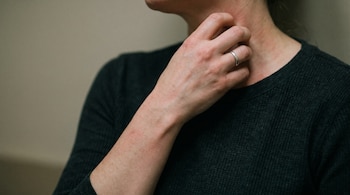 Primer plano de una persona rascándose el cuello y el antebrazo, mostrando enrojecimiento y marcas en la piel, con una camiseta oscura.