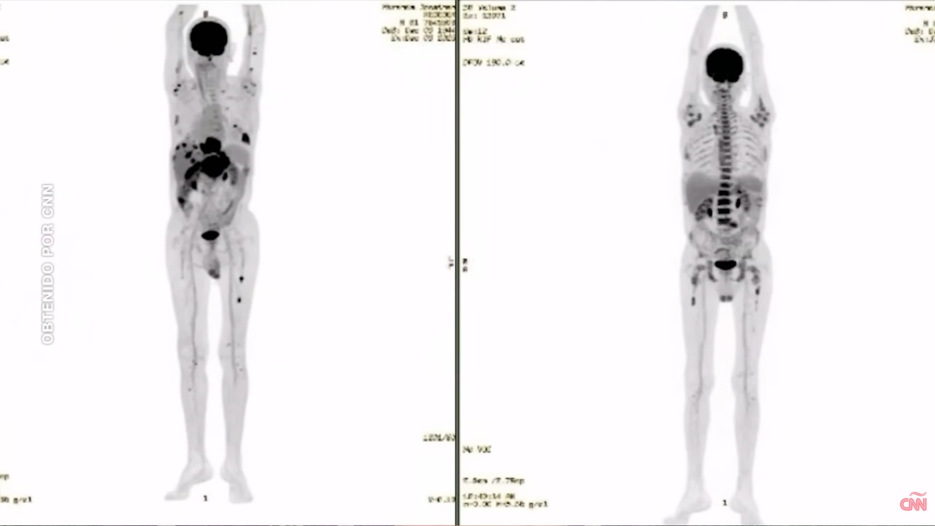 De metástasis en todo el cuerpo a remisión casi total en cuatro semanas