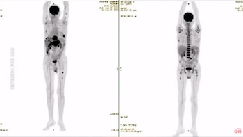 De metástasis en todo el