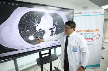 Cáncer al pulmón en Perú