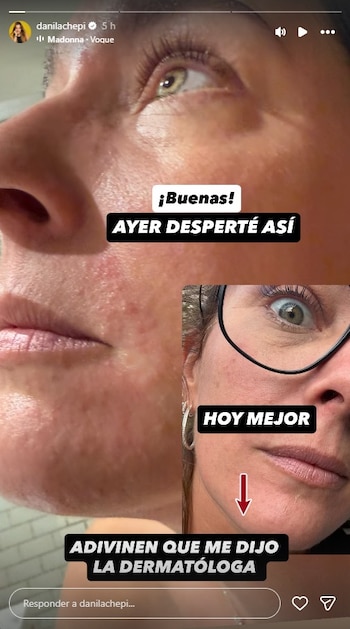 Un collage de dos primeros planos del rostro de Dani la Chepi, mostrando una erupción cutánea roja y pequeños granos