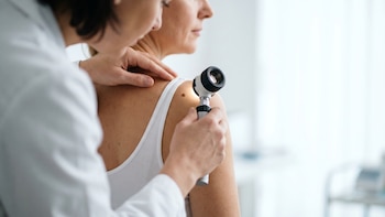 Melanoma en Argentina: cómo reconocer un lunar sospechoso y los errores más comunes al tomar sol