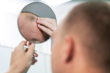 un hombre con alopecia mirándose al espejo