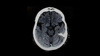 Parásito común que se oculta