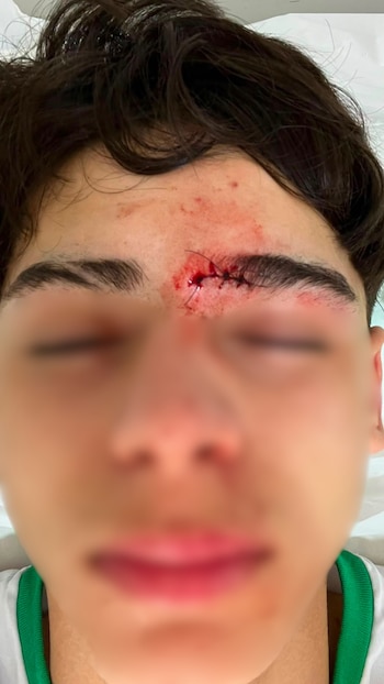 Uno de los menores heridos requirió puntos de sutura por un corte (Instagram)