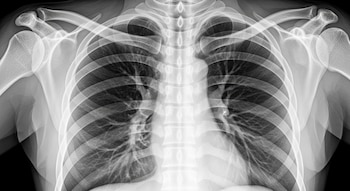 Una radiografía de tórax que muestra el esqueleto superior del cuerpo, incluyendo costillas, clavículas, hombros y la estructura de los pulmones.