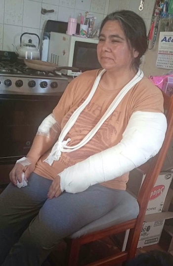 Una mujer sentada en una cocina, con ambos brazos vendados, un cabestrillo blanco en el cuello y una gasa en la mano derecha