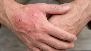 Primer plano de dos manos entrelazadas; la mano visiblemente afectada muestra una roncha grande, roja e inflamada con heridas superficiales en el dorso.