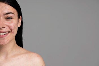 Las exfoliaciones deben evitarse en