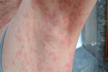 Uno de los nuevos síntomas