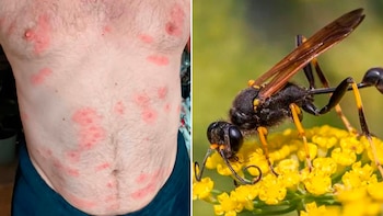 hombre - picaduras - avispas