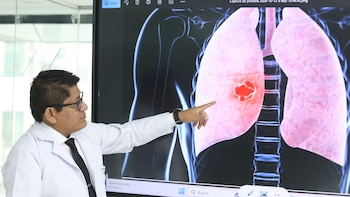 Cáncer al pulmón en Perú: Minsa y EsSalud emiten recomendaciones para evitar o tratar la lesión maligna
