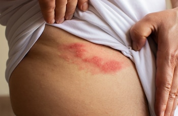 Herpes zóster (Shutterstock)