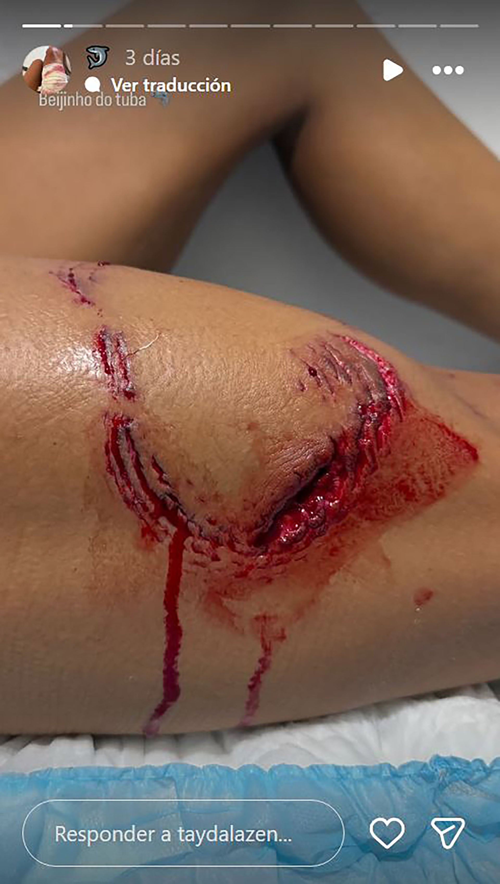 La fuerte herida que compartió la surfer tras el ataque del tiburón (Instagram / @taydalazen)