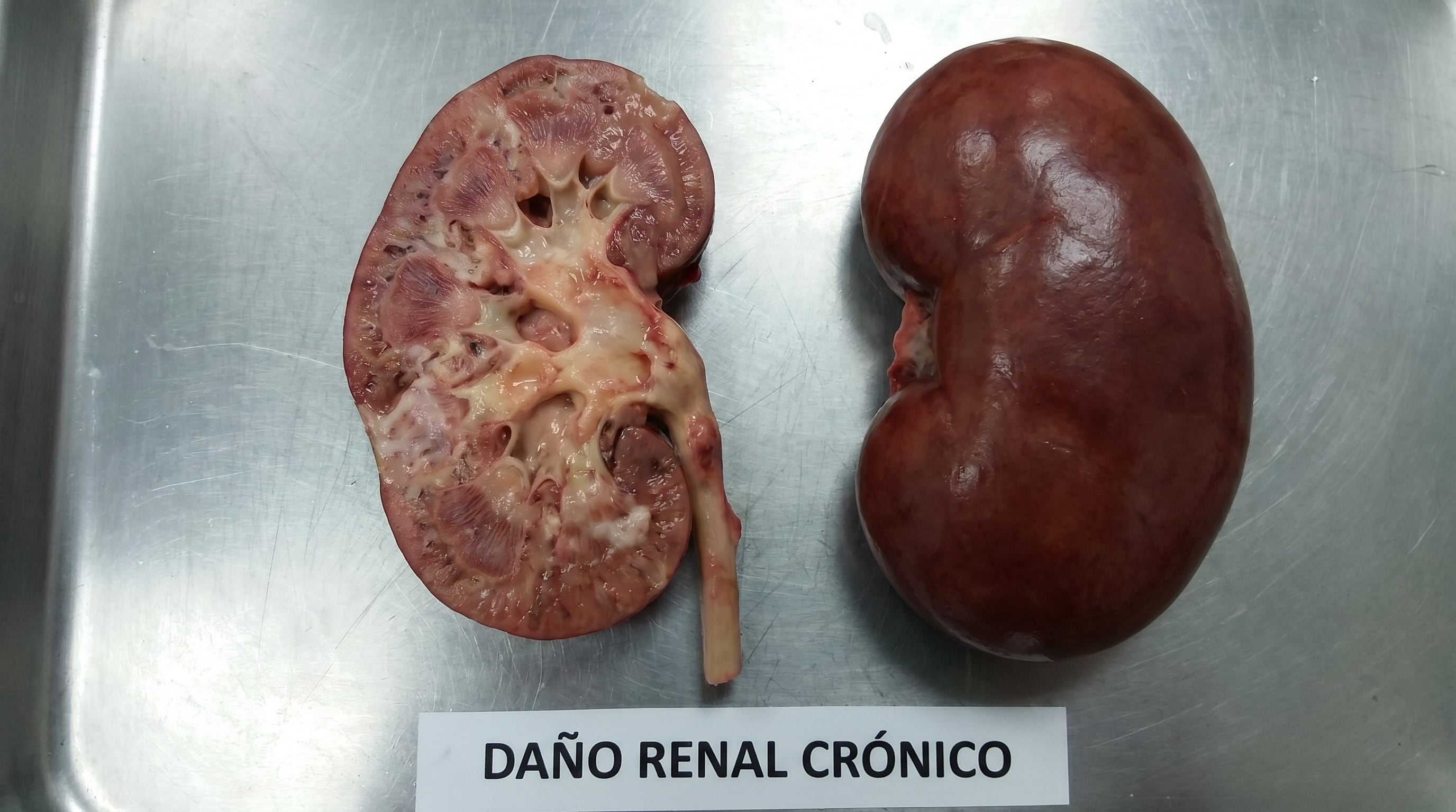Dos riñones, uno seccionado para mostrar el daño renal crónico, reposan sobre una superficie metálica en una demostración patológica de la enfermedad renal. (Imagen Ilustrativa Infobae)