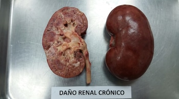 Dos riñones sobre una bandeja metálica; uno entero y otro seccionado que revela daño interno. Una etiqueta visible dice 'DAÑO RENAL CRÓNICO'.