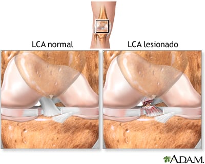 Según un ensayo clínico publicado por especialistas en Finlandia, quienes evitaron la cirugía de rodilla presentaron menos deterioro articular y redujeron la progresión de la osteoartritis tras diez años de seguimiento