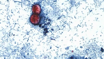 Reino Unido registra un aumento en casos de ciclosporiasis en viajeros que regresan de México