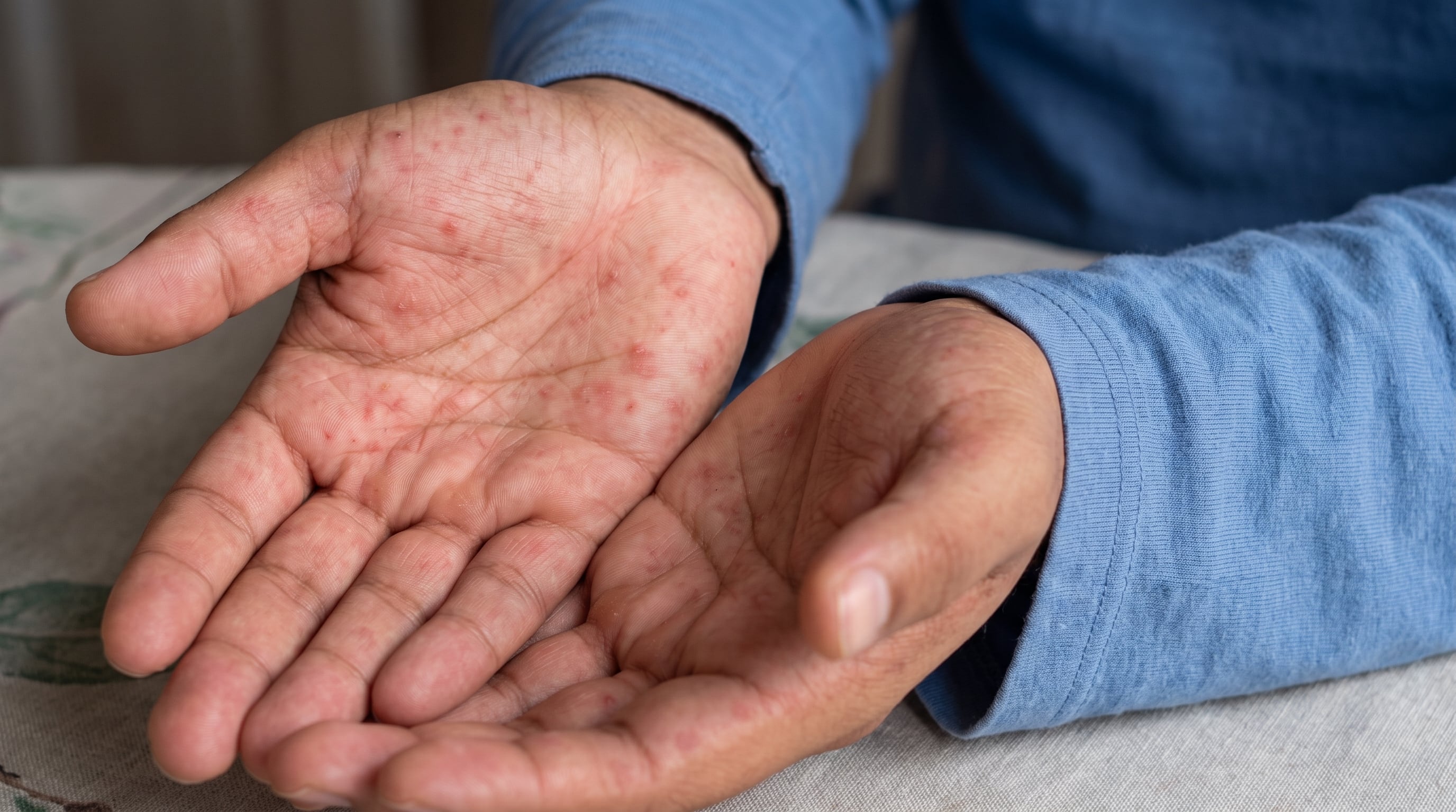 República Dominicana: Salud Pública confirma dos casos de viruela símica en San Cristóbal