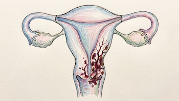 “Misiles teledirigidos”: la ciencia estudia nuevos métodos para luchar contra el cáncer de cuello uterino