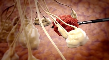 Ilustración 3D: Instrumento quirúrgico extirpando un tumor rojo irregular, rodeado de células pálidas con tallos largos sobre un fondo de tejido rosado.